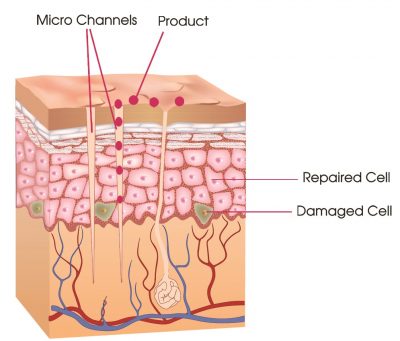 Channel Pro 2.0 Micro channeling Machine