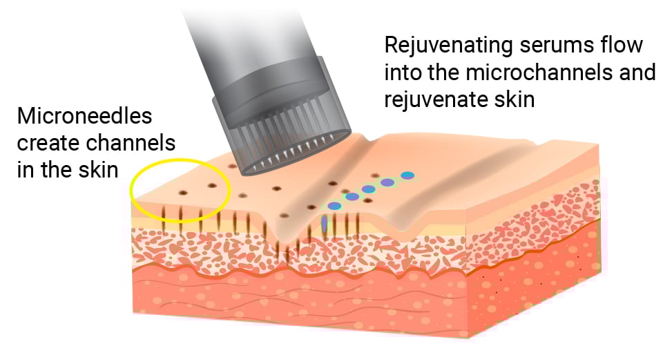 Channel Pro 2.0 Micro channeling Machine