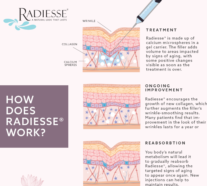 Radiesse 2 X 1.5cc